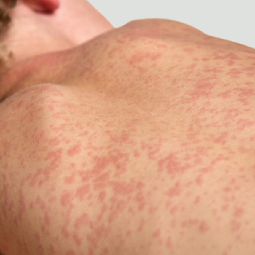 sarampo no brasil com aumento de risco de contágio e surtos